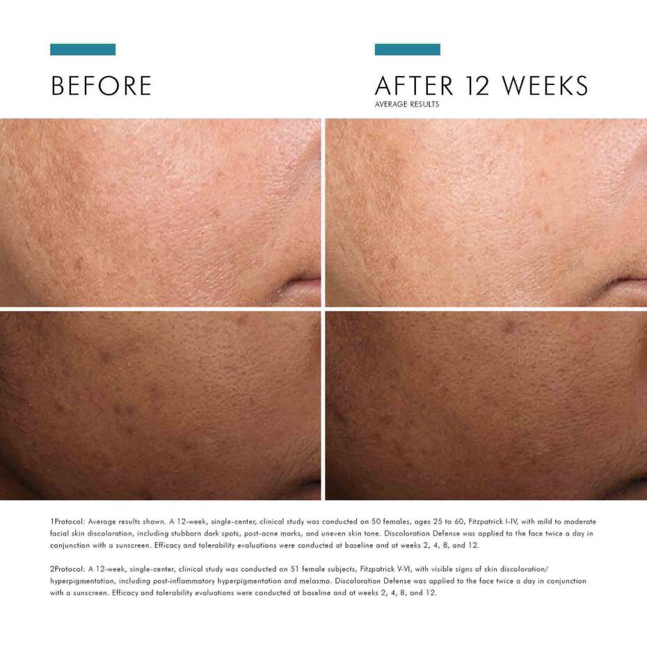 Before and after comparison of skin treatment results on a person's face.