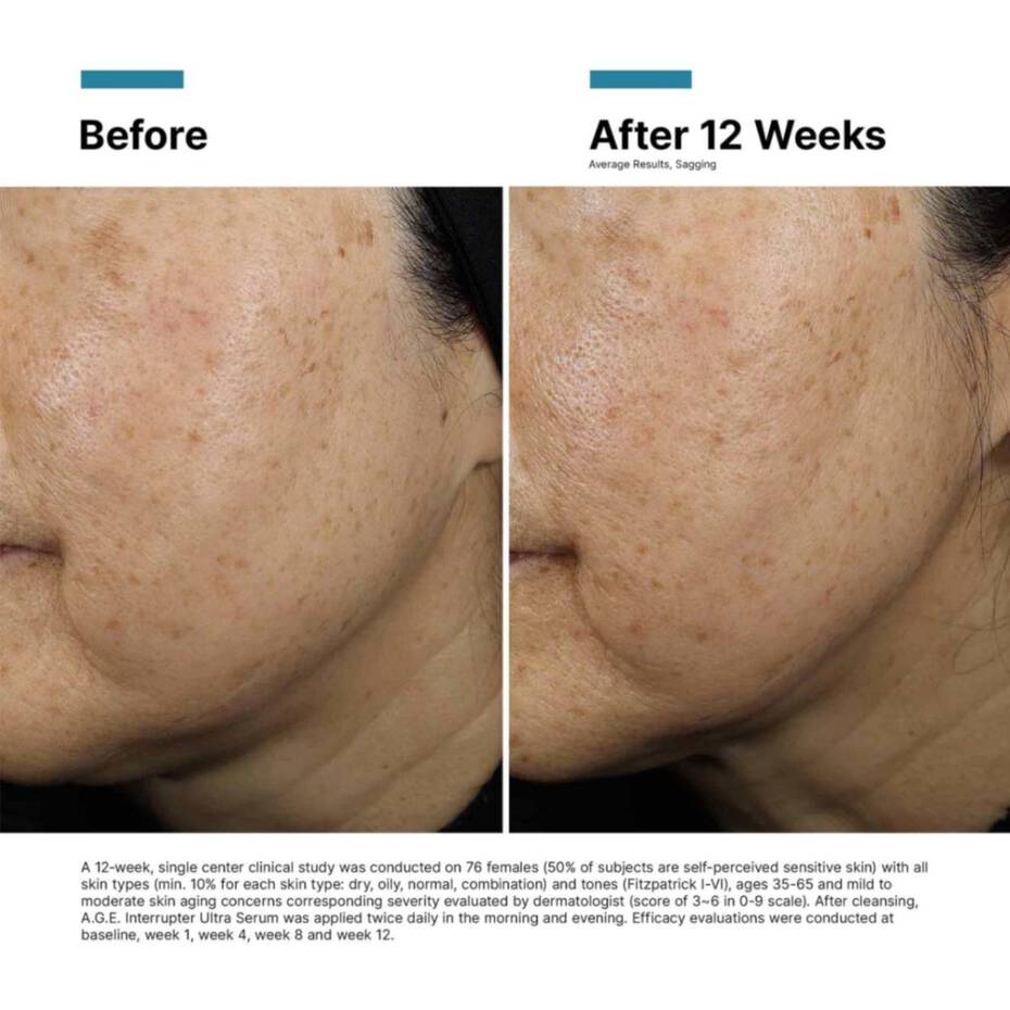 Before and after comparison of skin treatment on a person's face, showing reduced acne and improved texture.