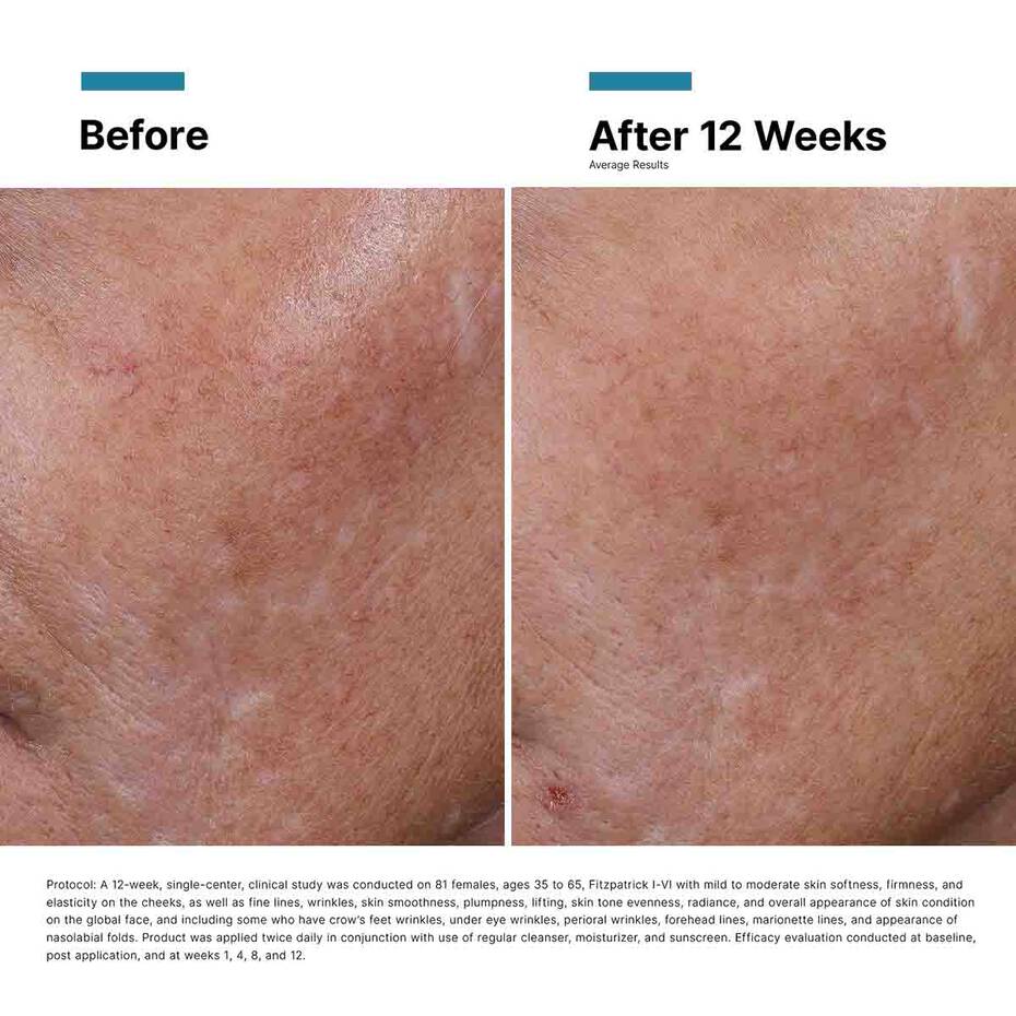 Before and after comparison of skin treatment showing improvement over 12 weeks.