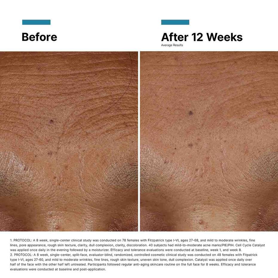 Before and after comparison of skin texture improvement over 12 weeks.
