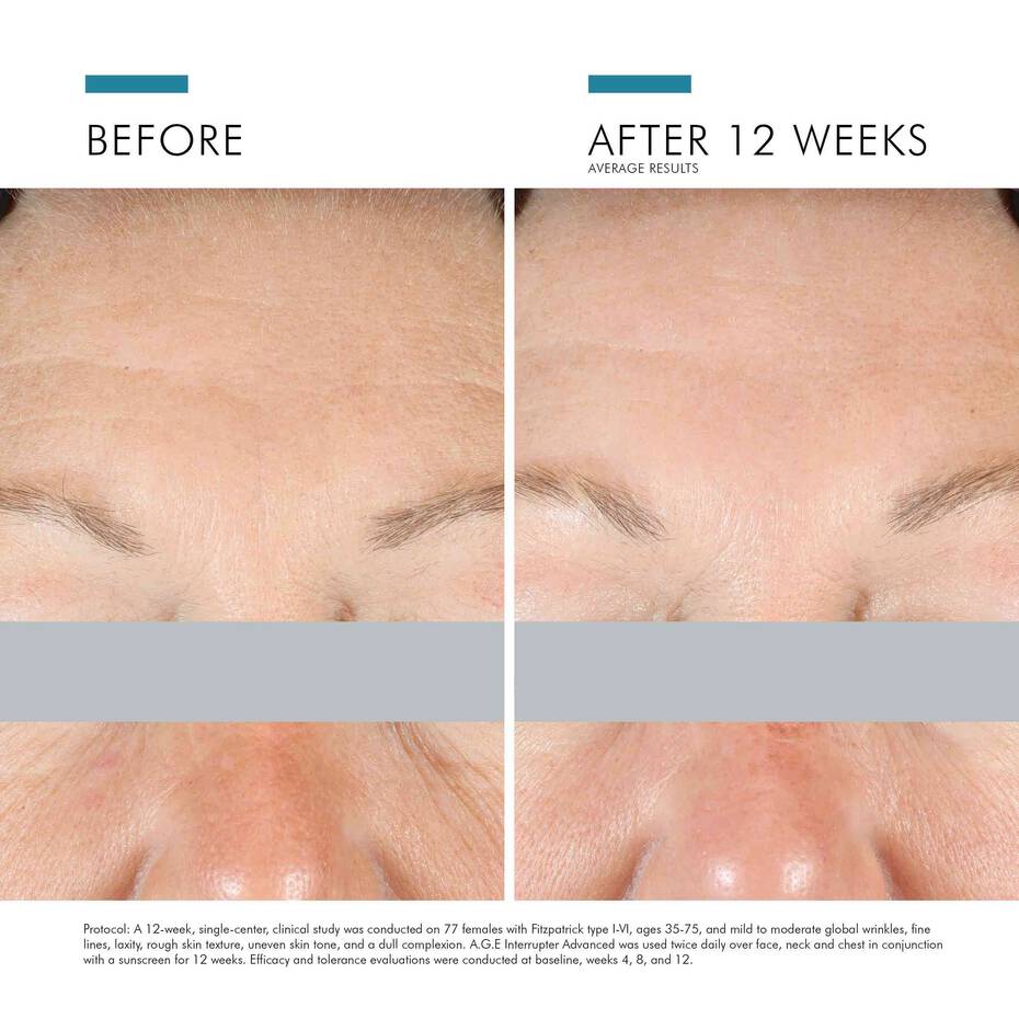 Before and after comparison of skin texture on a person's face, showing improvement after 12 weeks.