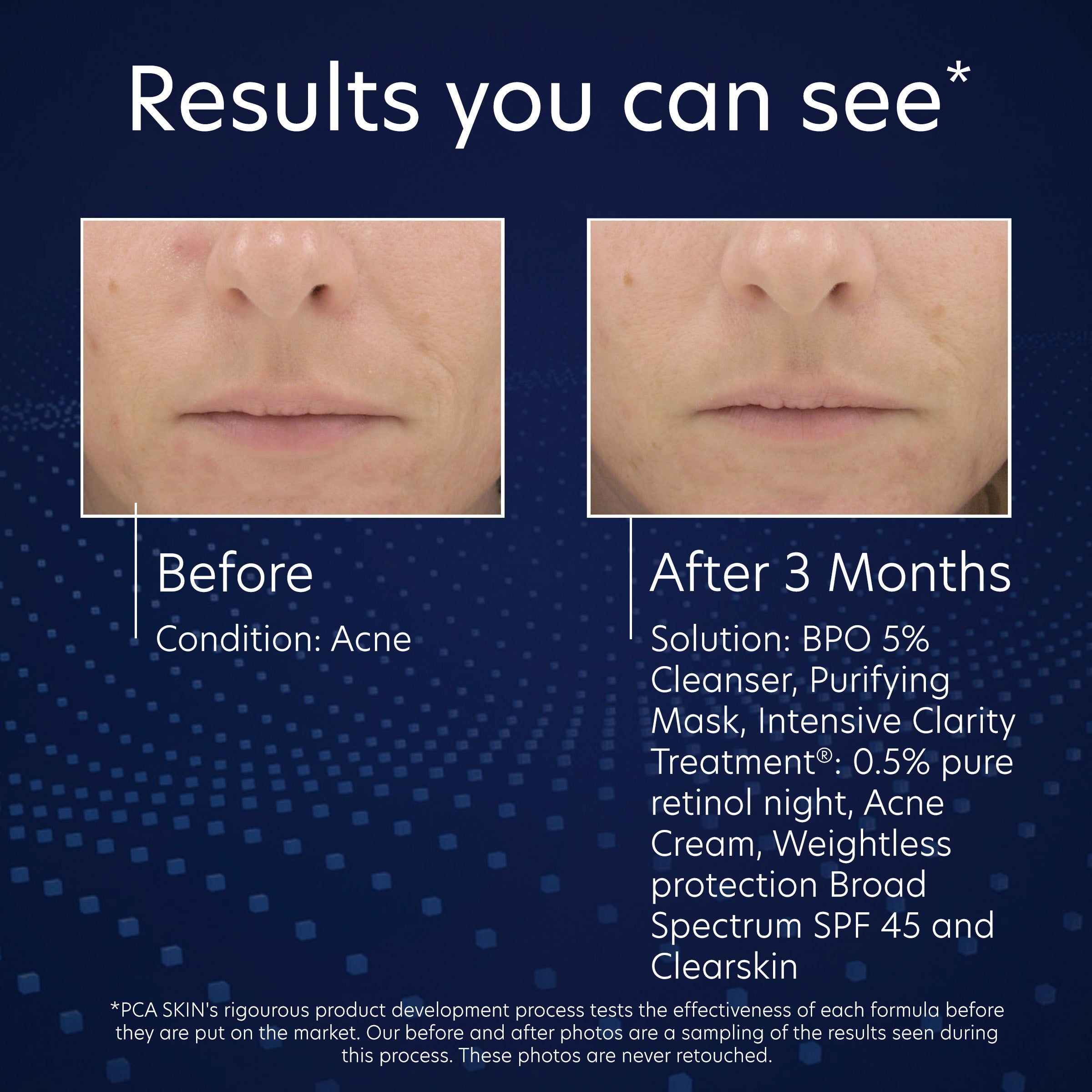 Before and after skin treatment results showing acne improvement with product names listed.