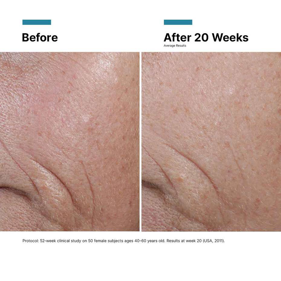 Before and after comparison of skin texture improvement over 20 weeks.