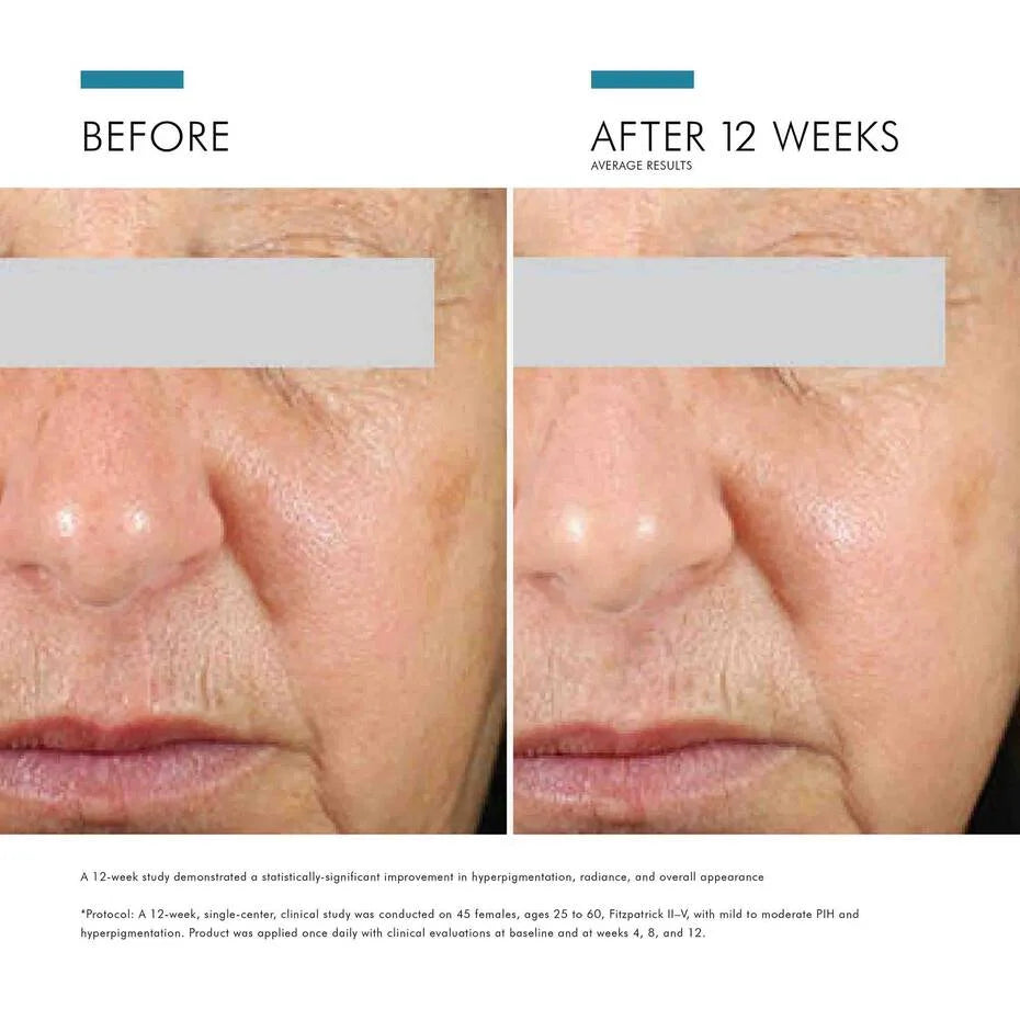 Before and after comparison of skin treatment results on a person's face.