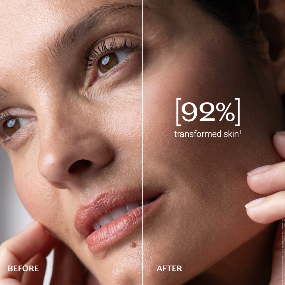 Before and after comparison of a woman's face with text indicating 92% transformed skin.