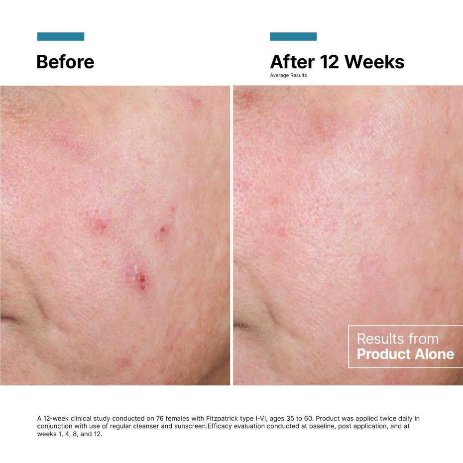 Before and after comparison of skin treatment results on a person's shoulder.