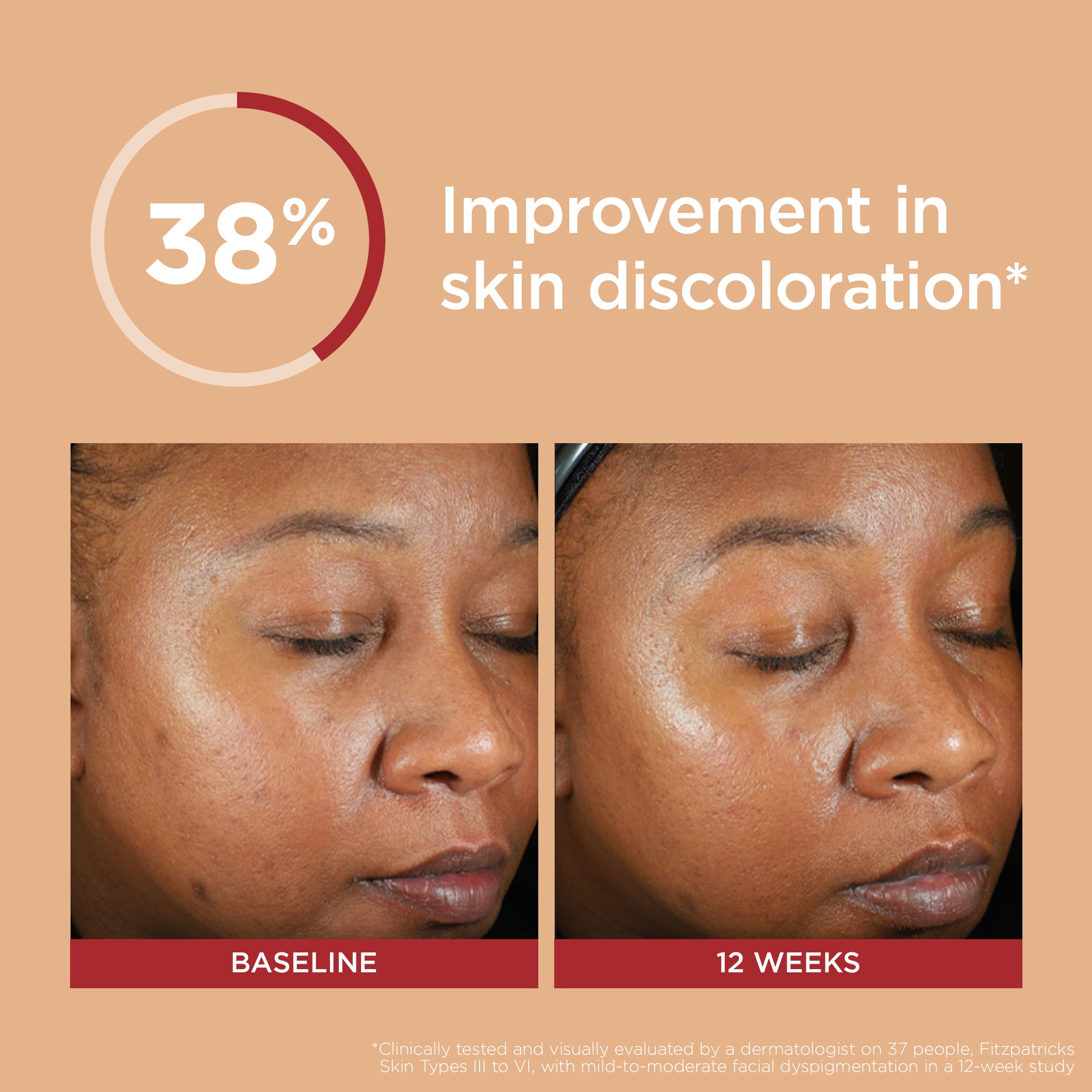 Before and after comparison of skin discoloration improvement with a 38% increase shown on a beige background.