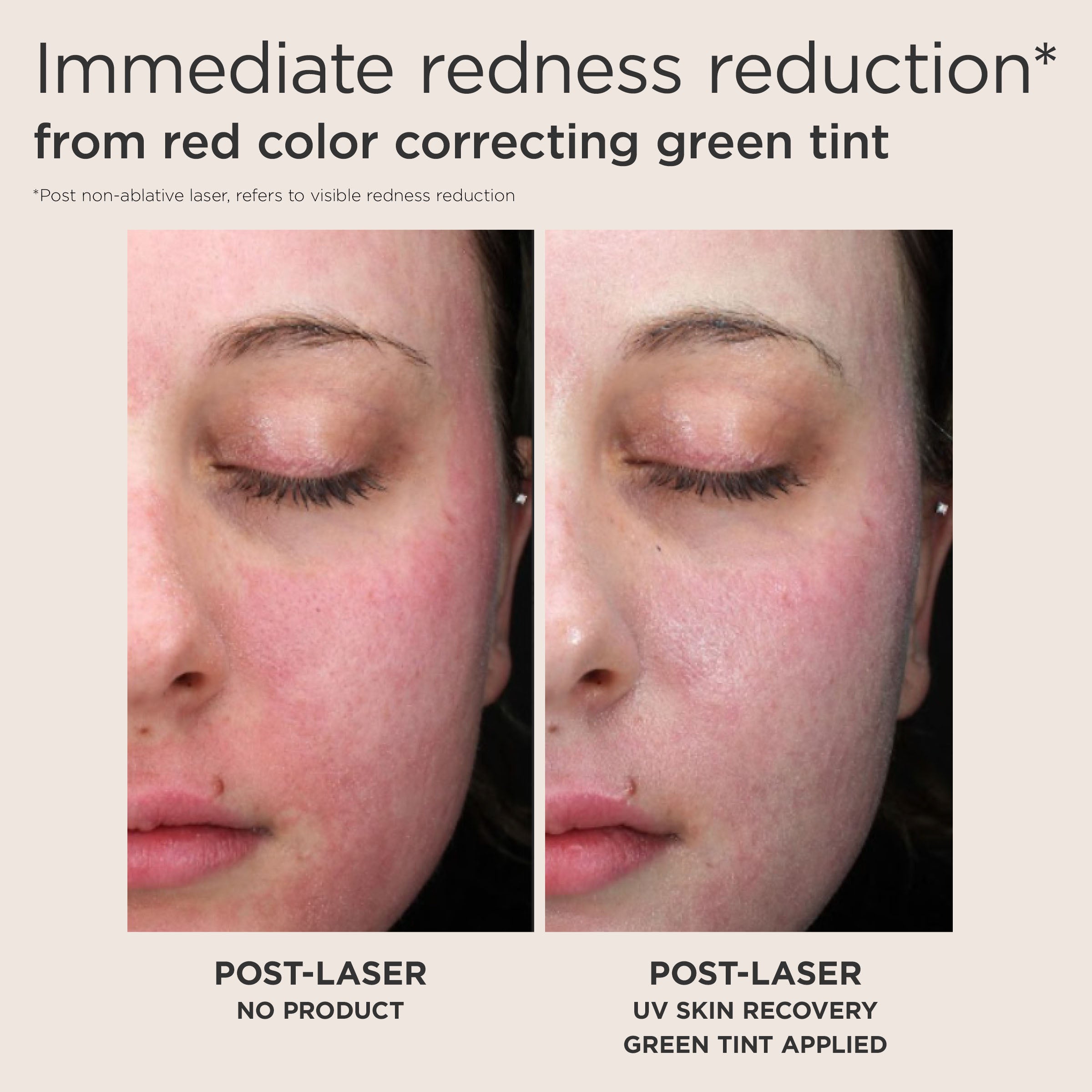 Before and after comparison of a woman's face with redness reduction using a green tint post-laser treatment.